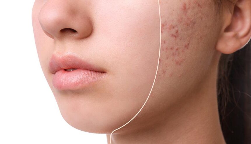 Rekomendasi Skincare Mengatasi Jerawat dan Bekasnnya
