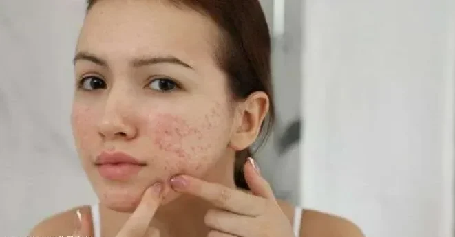 Rekomendasi Skincare Mengatasi Jerawat dan Bekasnnya