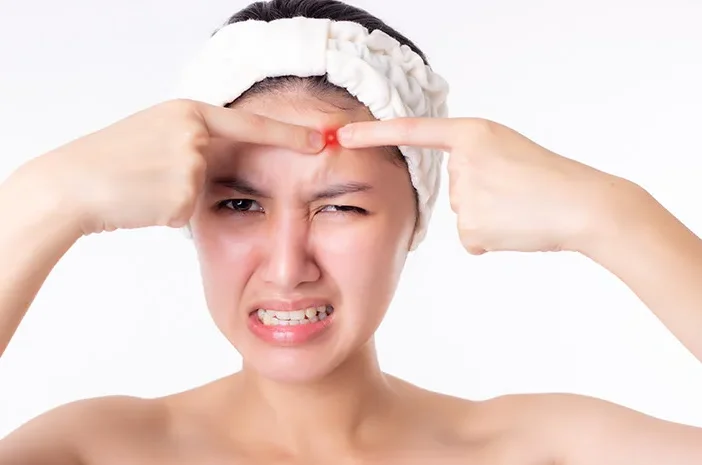 Cara Alami Hilangkan Jerawat di Jidat, Coba 3 Tips Ini