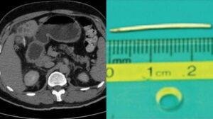 Tak Sengaja Telan Tulang Ikan, Bikin Liver Pria ini Rusak! Simak Lengkapnya