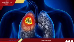 Pakar Kesehatan Menyebut Rokok Sebagai Pemicu Utama Kanker